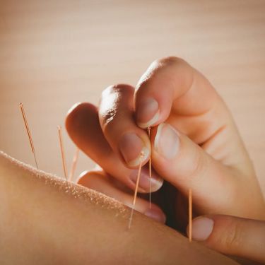 Click Here To Enlarge This Photo Of ACUPUNCTURE