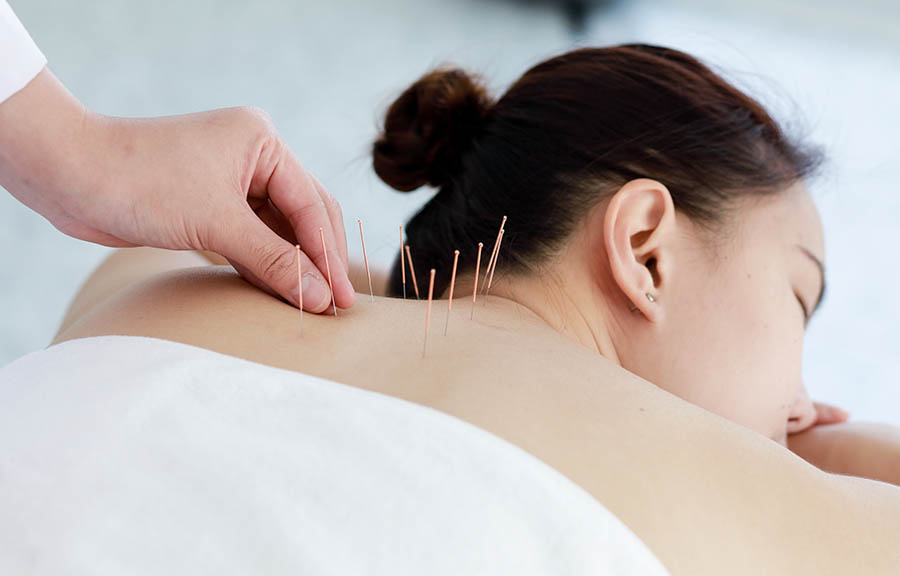 Acupuncture