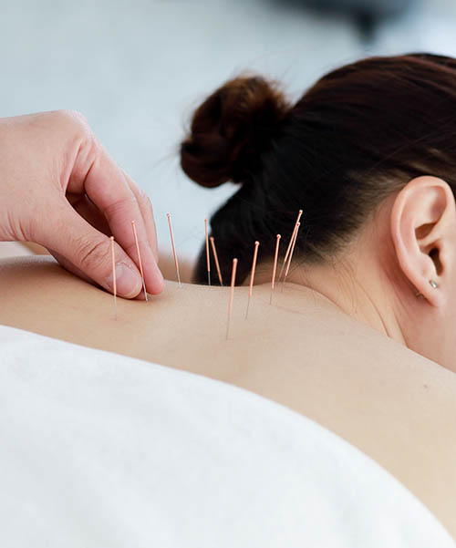 Acupuncture